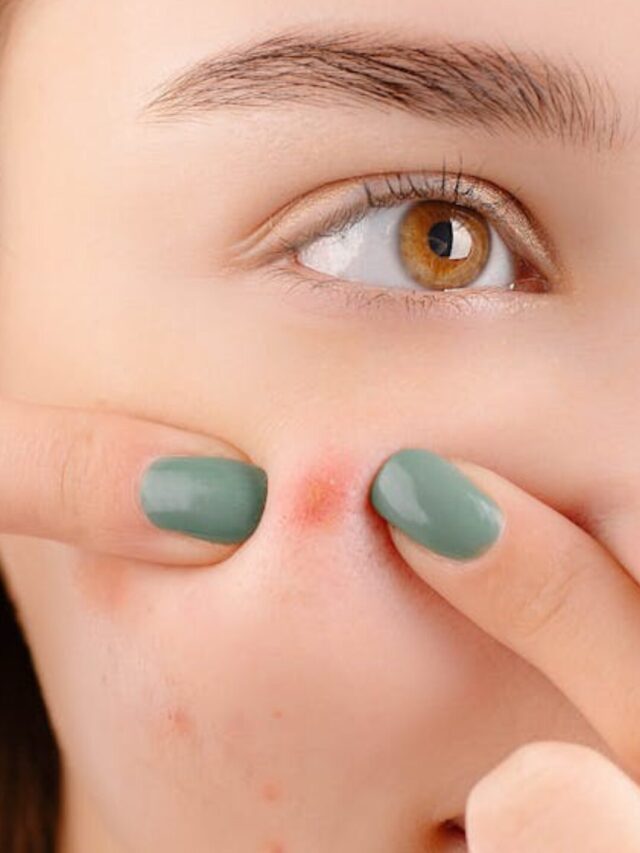 मुँह धोने के बाद भी क्यों आते हैं पिंपल्स?